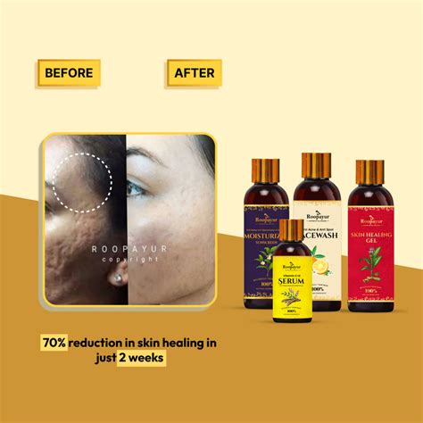 Best Acne Scar Healing Combo – Reduce Acne Pits, Dark Spots, & Shrink