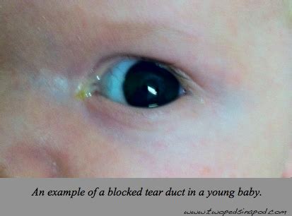 Newborn eyes: blocked tear ducts, crossed-eyes, vision, and eye color ...