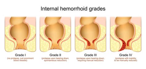 Grade 4 Hemorrhoids