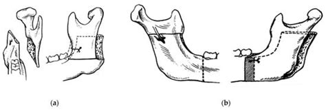 Sixty Years of Innovation in Biomechanical Orthognathic Surgery: The ...