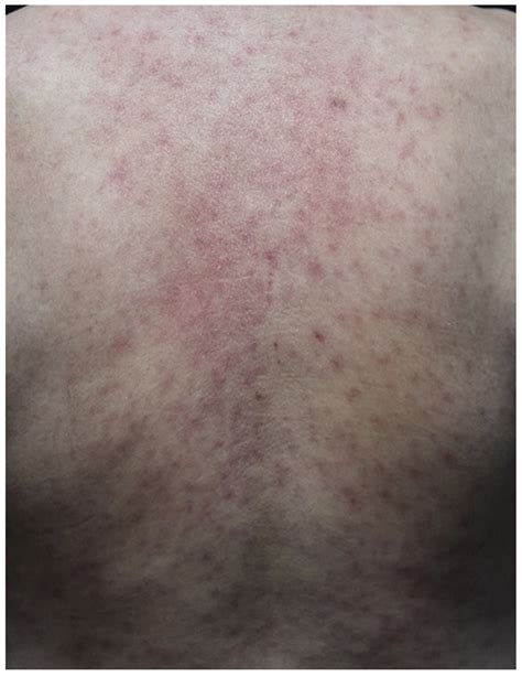 Cutaneous Adverse Events Associated with Immune Checkpoint Inhibitors ...