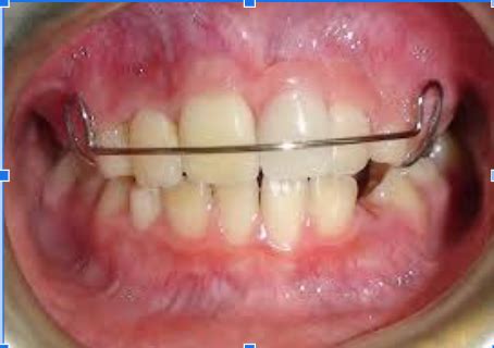 Image result for Retainer Problems