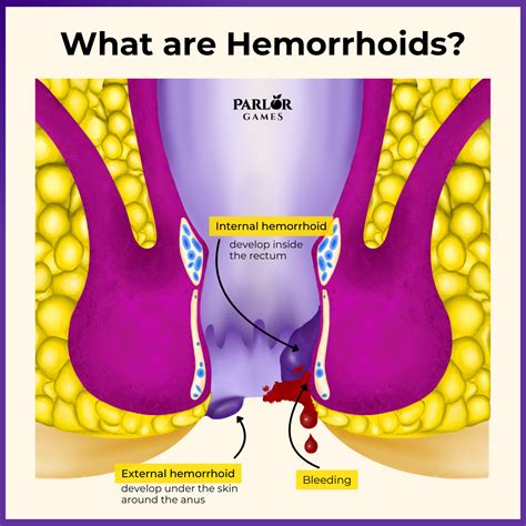 How menopause can cause hemorrhoids