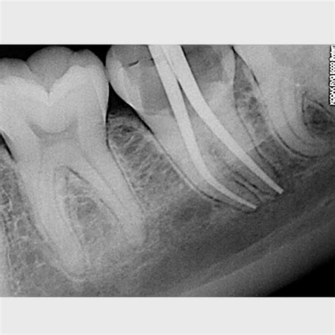 Root Canal Treatment in Noida | Dr. Jain’s Dental Care