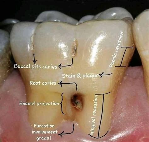 Image result for Tooth Stain