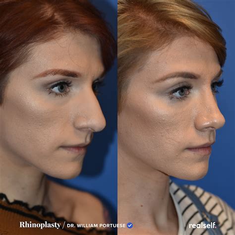Rhinoplasty: The Ultimate Guide to a Nose Job - RealSelf | Rhinoplasty nose jobs, Rhinoplasty ...
