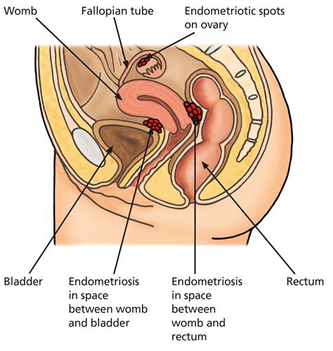 How Common Is Endometriosis