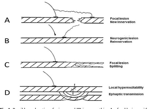 Image result for Single Fiber EMG Test