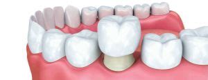 Fixed dental prosthetics in Kyiv Osokorky | DENTA UA