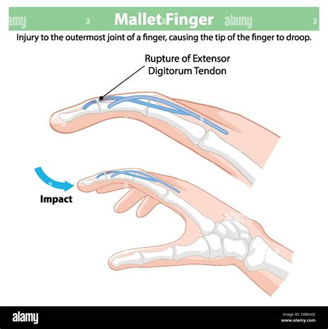 Mallet Finger Diagram at Clyde Patterson blog