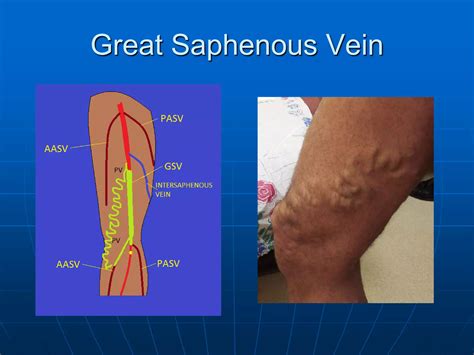 The Great Saphenous Vein | PDF
