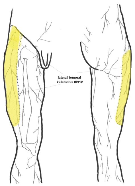 Meralgia Paresthetica—An Approach Specific Neurological Complication in Patients Undergoing DAA ...