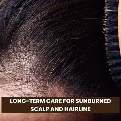 Best Remedies for Sunburn on Your Scalp and Hairline | Clinikally