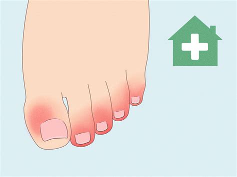 How to Treat Trench Foot: Symptoms & Causes (With Pictures)