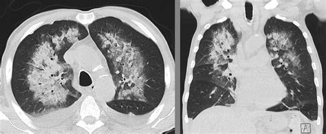 Alveolar Hemorrhage Radiology at Howard Roberts blog