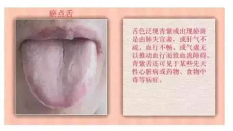 珍贵舌诊：脾胃湿寒、肝脾不和的舌象（转）舌与人体内脏有什么关系呢？中医认为，舌尖代表心肺，舌中代表脾胃，舌根代表肾，舌两... - 雪球