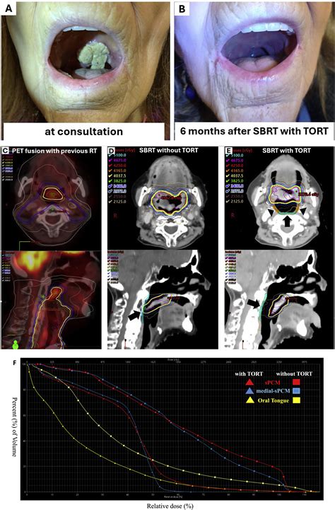 Pharyngeal Constrictor-Sparing Salvage Stereotactic Body Radiation ...