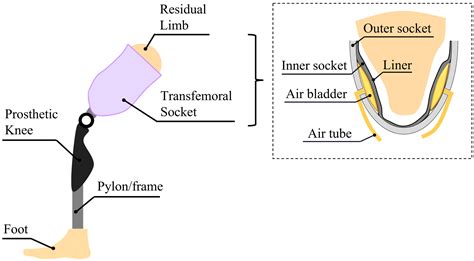Types Of Transfemoral Sockets at Murray Baxter blog