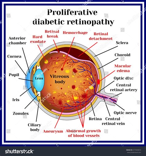 Nonproliferative Diabetic Retinopathy Vs Proliferative