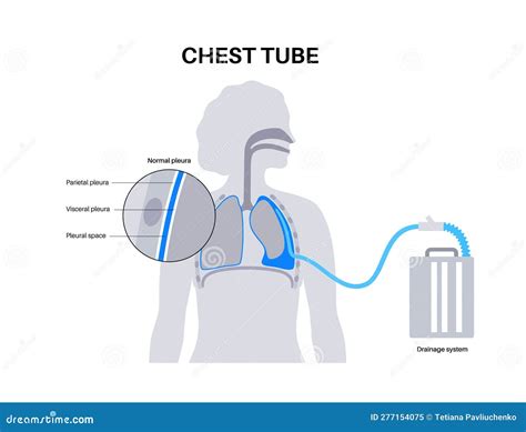 Chest tube catheter stock vector. Illustration of thorax - 277154075