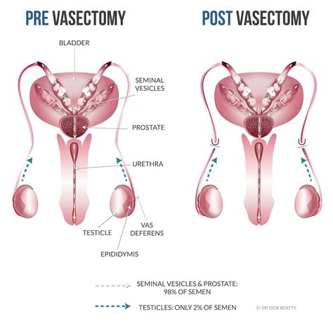 Sex After Vasectomy