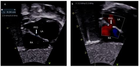 Patent Foramen Ovale in Fetal Life, Infancy and Childhood