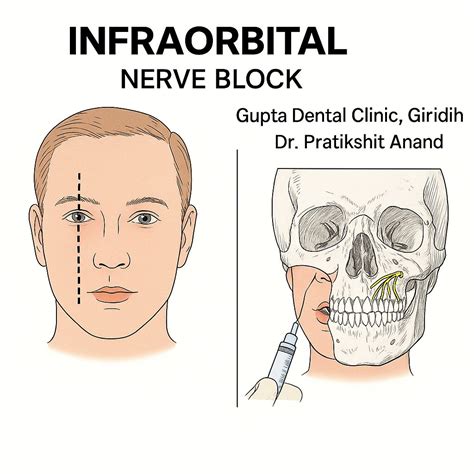 How to Master the Infraorbital Nerve Block | Dr Pratikshit Anand posted ...