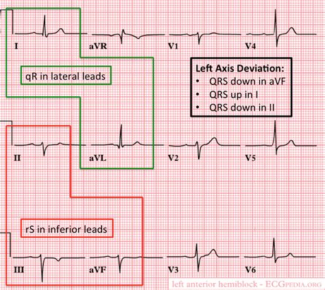 Left Posterior Fascicular Block