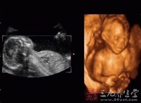 怀孕29周胎儿彩超图_百度宝宝知道-我们这里没有四维彩超 请问普通彩超能检查出胎儿畸形吗