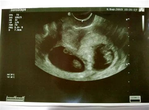 这个孕周“胚胎”变成“胎儿”，生命真正开始，别当妈了还不知道_宝宝