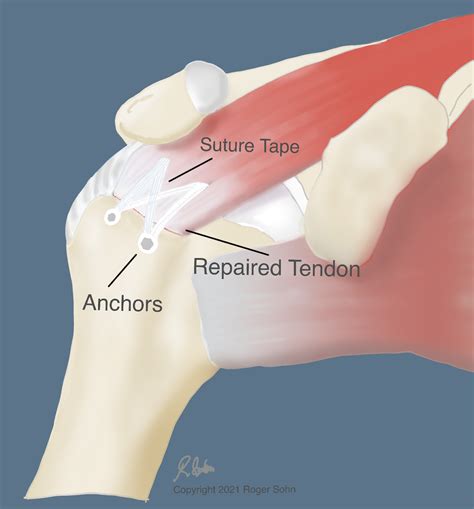 Image result for Rotator Cuff Repair Photo