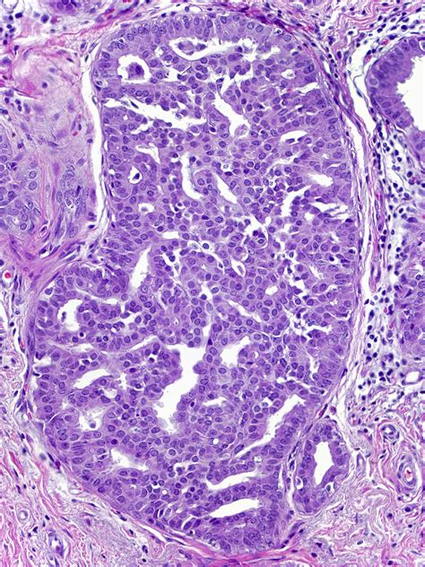 Atypical Ductal Hyperplasia (ADH) - MGH Learn Pathology