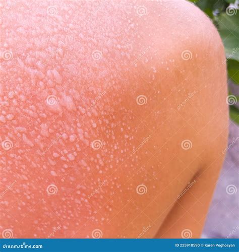 Blisters on the Back from Sunburn. a Young Guy on Vacation at the Beach Caught Fire from the ...
