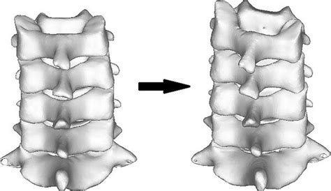 Image result for Left Cervical Rotation