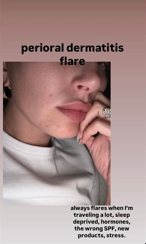 Hailey Bieber gets candid about her dermatitis flare-ups and how she ...