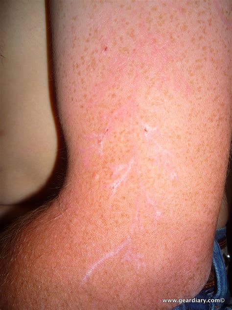 Meet Winston Kemp, Lightning Strike Survivor and Lichtenberg Figure Owner