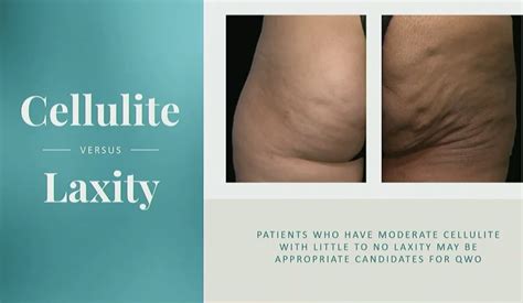 QWO Cellulite Treatment | Injection, No Downtime | QWO Cincinnati