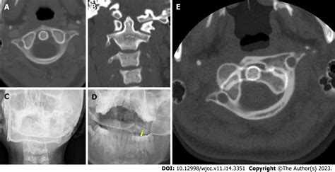 Iatrogenic atlantoaxial rotatory subluxation after thyroidectomy in a ...