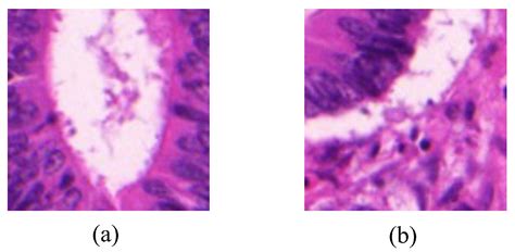 Weakly Supervised Gland Segmentation Based on Hierarchical Attention ...