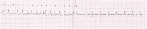Image result for Atrial Flutter Synchronized Cardioversion