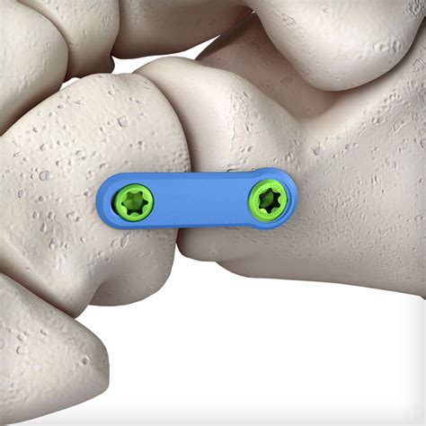 Compression Plate Ankle 的图像结果