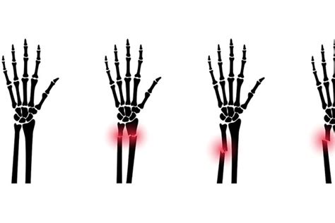 Image result for Distal Radius Fracture Recovery