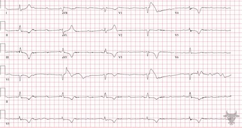 Third Degree Atrioventricular Block | ECG Stampede