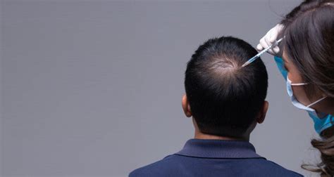 Dihydrotestosterone How It Causes Hair Loss and How to Slow It - Auric