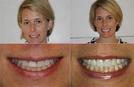 Image result for Veneers Before and After
