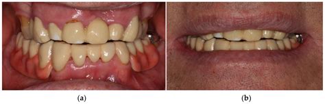 Polyoxymethylene as Material for Removable Partial Dentures—A ...