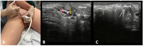 Management of Extra-Pelvic Varicose Veins of Pelvic Origin in Female ...