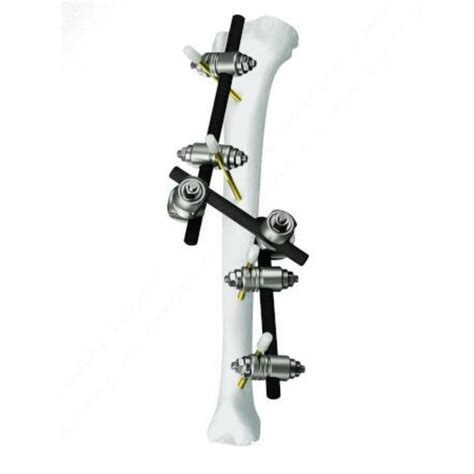 Image result for External Fixation Explained