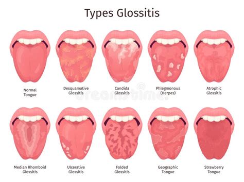 Glossitis. Scarlet Tongue Disease Types, Human Mouth Sore Teeth Problem ...