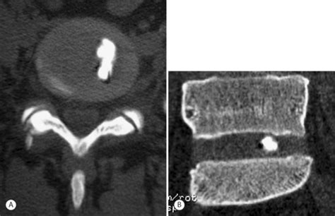 Image result for Lumbar Discogram